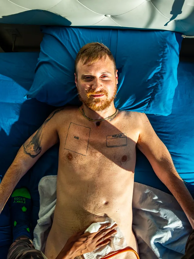 A shirtless person lies on a blue bed with chest and abdominal scars visible.