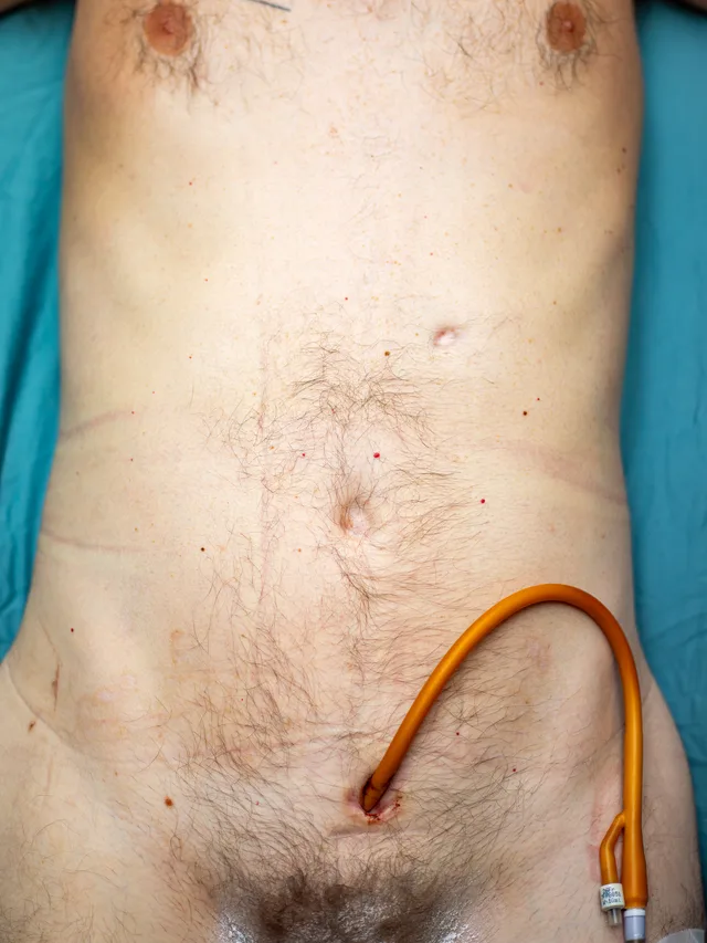 Close-up of a scarred abdomen with an orange catheter tube curving across it.